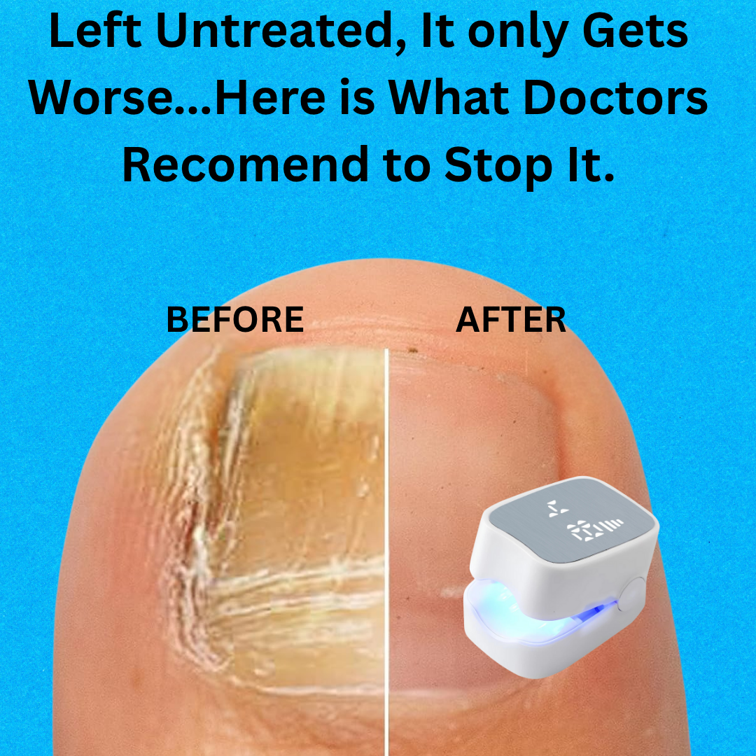 PureNail Pro™ - Nail Fungus Treatment Device