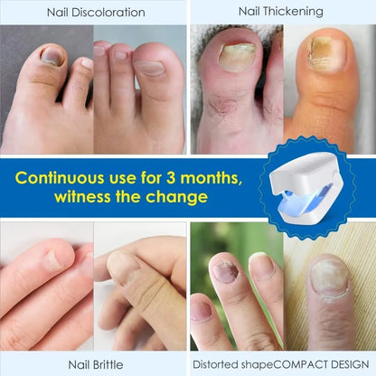 PureNail Pro™ - Nail Fungus Treatment Device